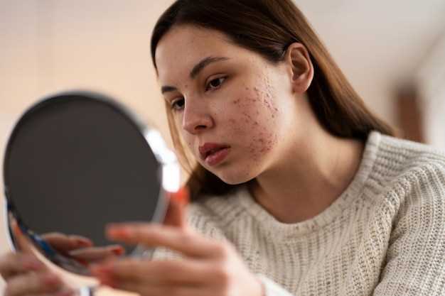 Side effects of doxycycline for acne