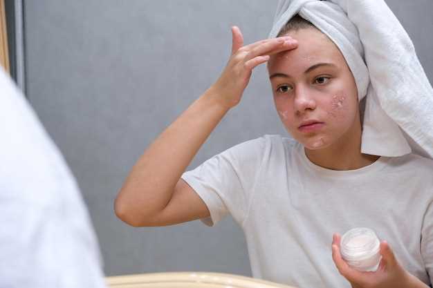 Benefits of Doxycycline for Acne Treatment