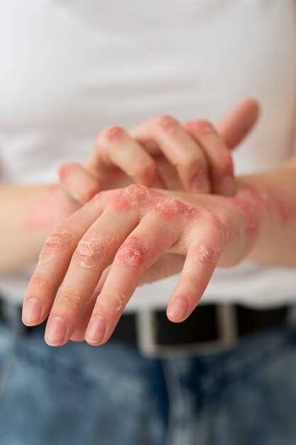Causes of Seborrheic Dermatitis