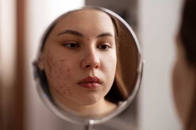 Does doxycycline get rid of acne