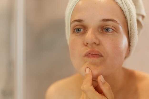 Doxycycline acne effectiveness
