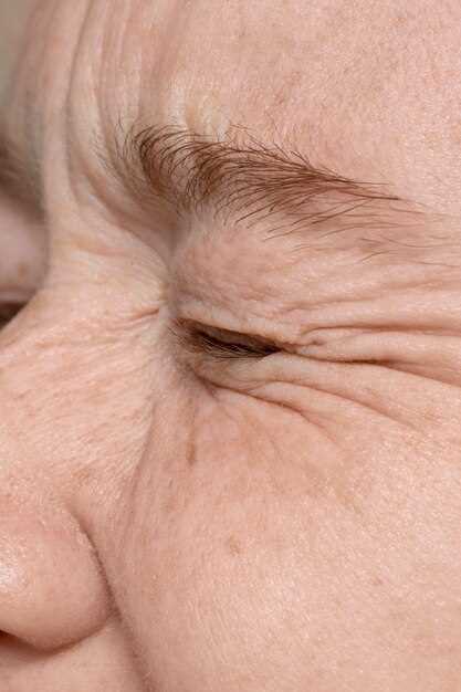 Doxycycline after fraxel