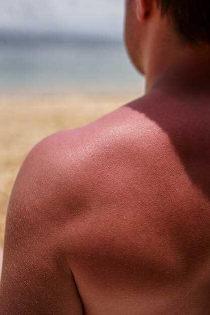 Doxycycline after sun