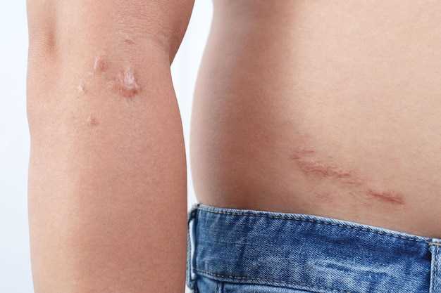 Doxycycline and scabies