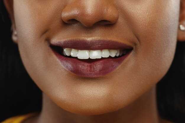 Doxycycline black teeth