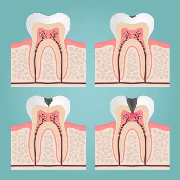 Doxycycline gingivitis