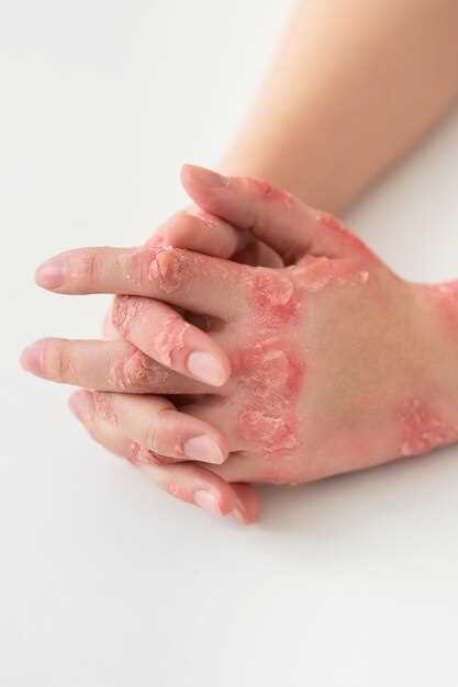 Doxycycline hyclate psoriasis