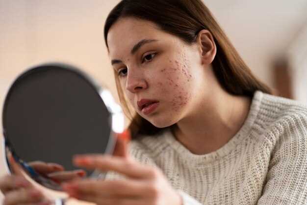 Doxycycline mono and acne