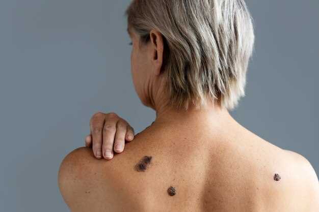 Doxycycline sebaceous cysts
