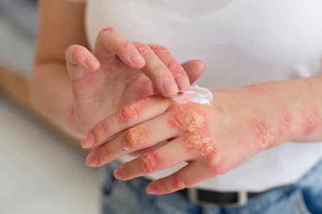 Doxycycline seborrheic dermatitis