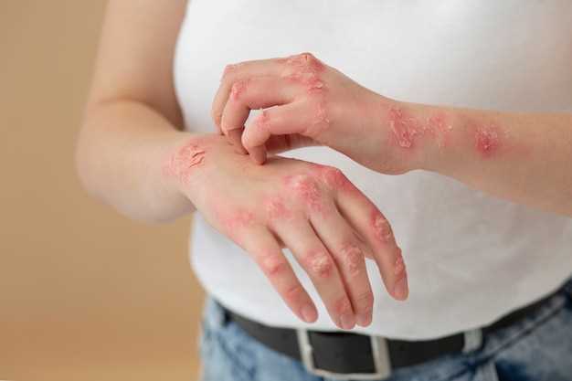 Doxycycline staph skin infection