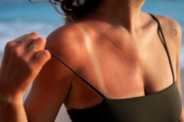 Doxycycline sunburn