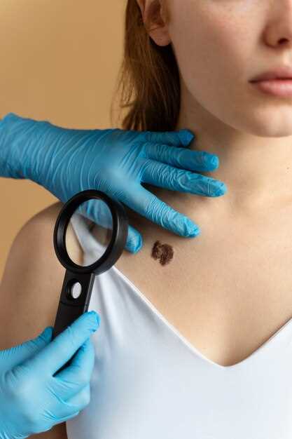 Hidradenitis suppurativa treatment doxycycline
