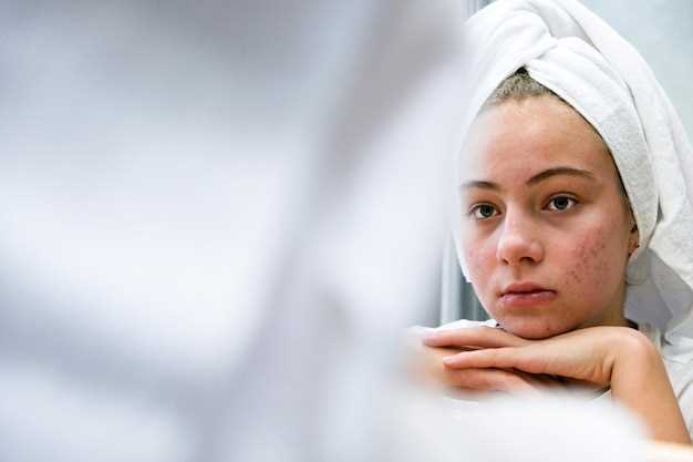 How long do you have to take doxycycline for acne