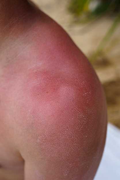 Images of doxycycline rash