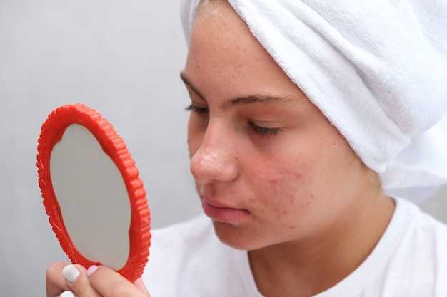 Is doxycycline good for acne scars