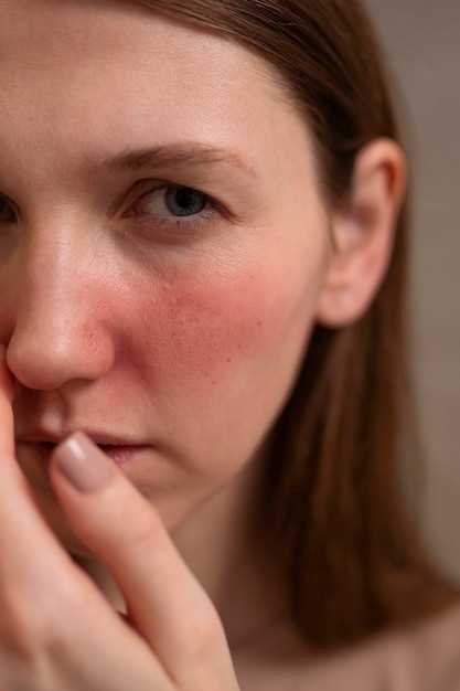 Rosacea doxycycline side effects