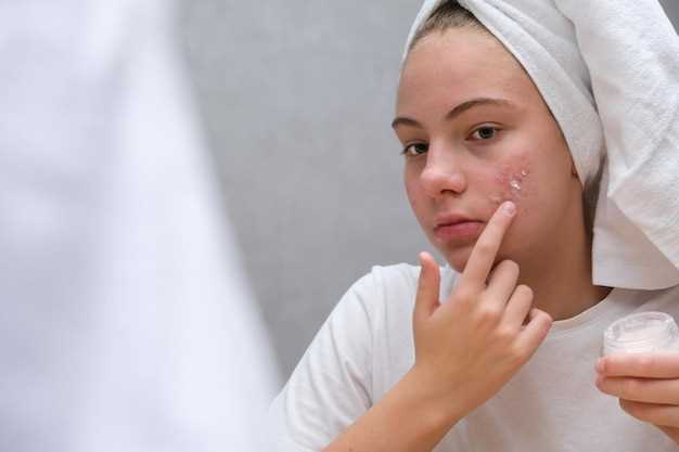 Short term doxycycline for acne